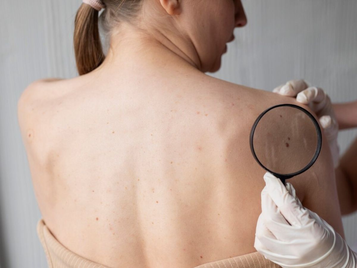 Melanoma cutaneo: sintomi iniziali, fattori di rischio e prevenzione