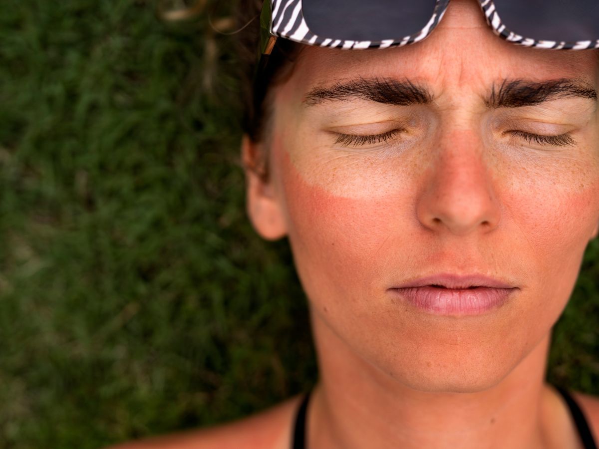 Prevenzione delle scottature solari: consigli e prodotti efficaci